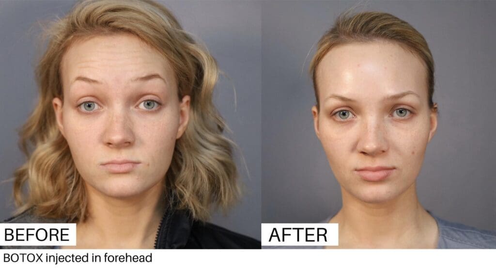 Botox before and after