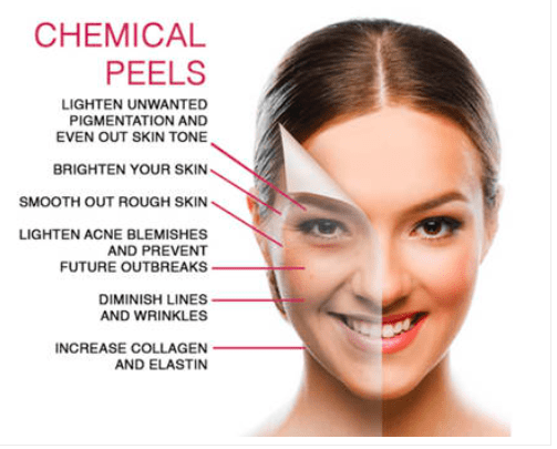 Chemical peel infographic