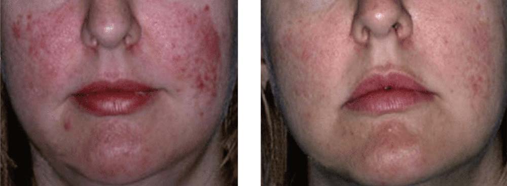 IPL acne rosacea before and after