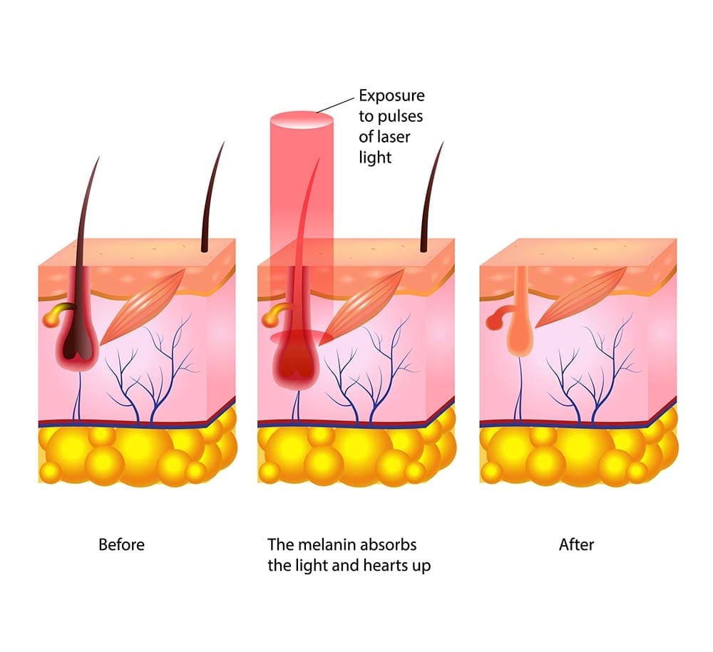 Laser hair before and after infographic