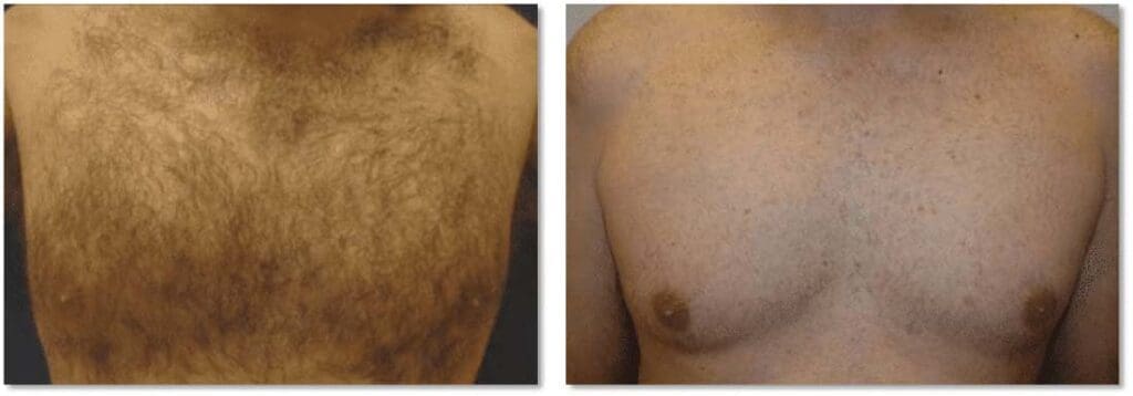 Chest hair removal before and after