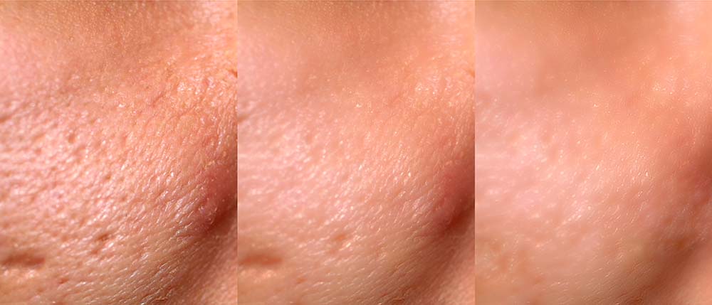 Before and after laser treatment on acne scars
