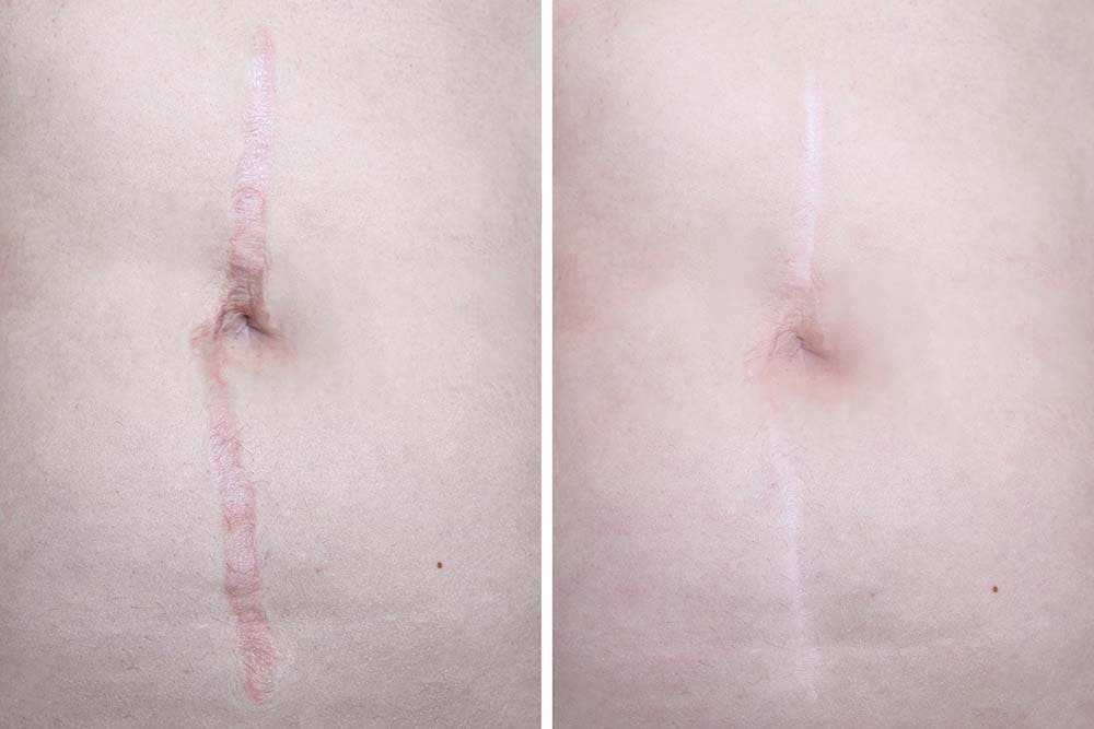 Scar removal on stomach