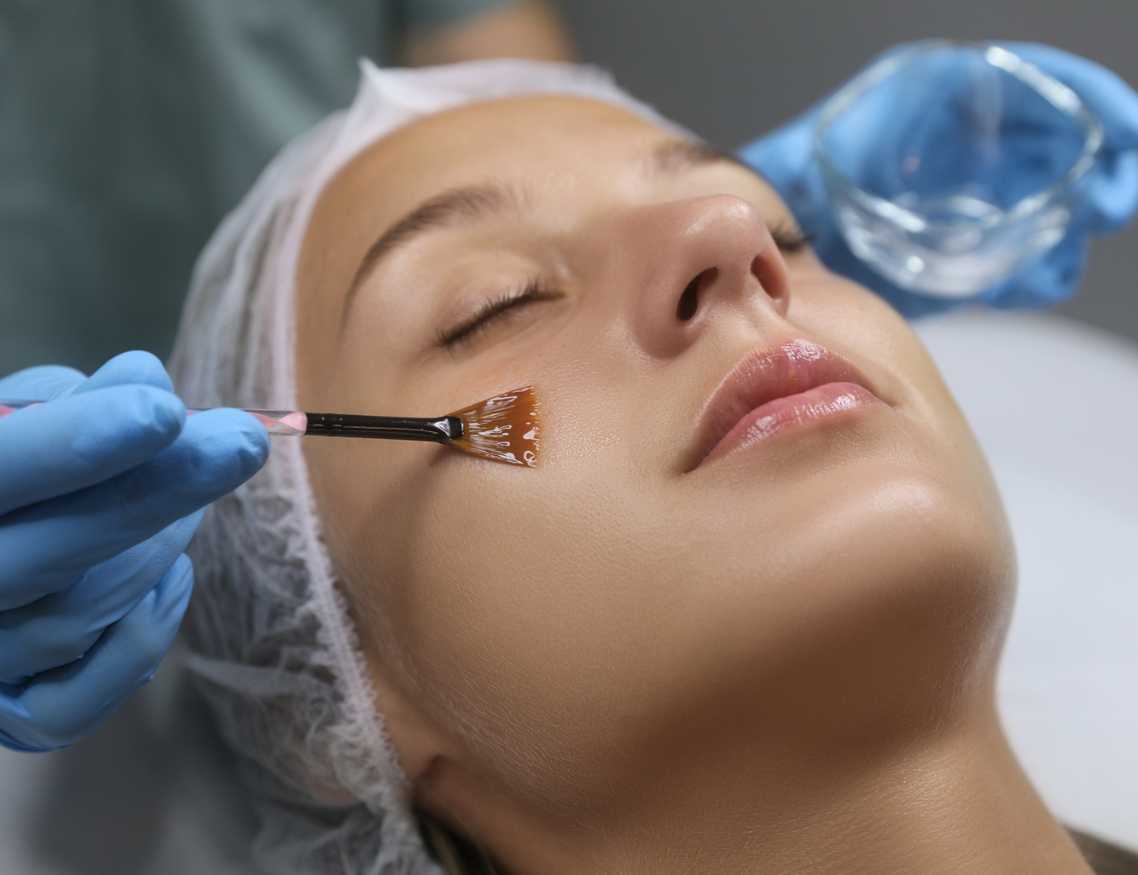 Chemical peel treatment