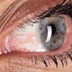 Dry eyes treatment