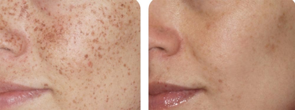 Before and after of IPL treatment