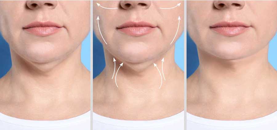 Kybella before and after