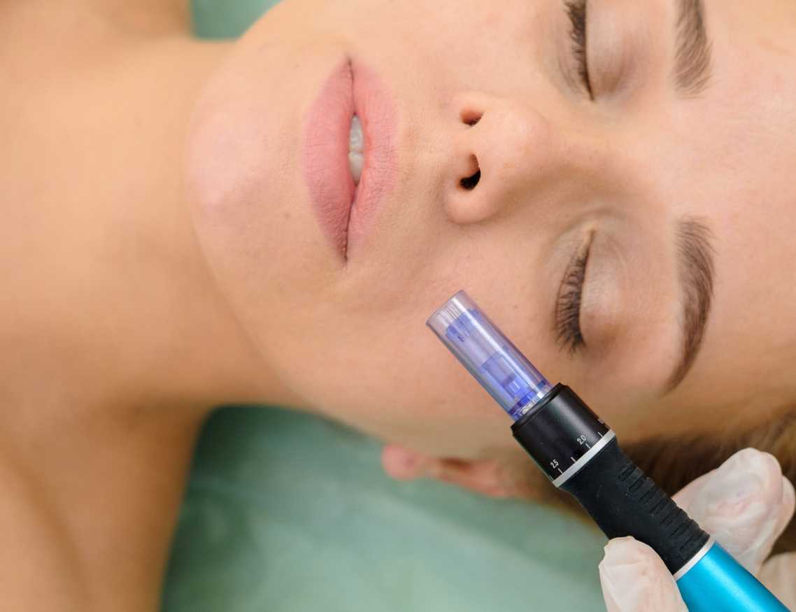 Woman getting Microneedling