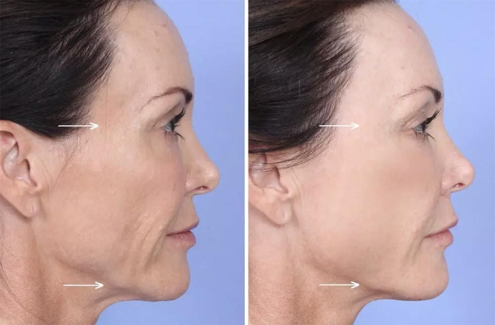 Sculptra before after