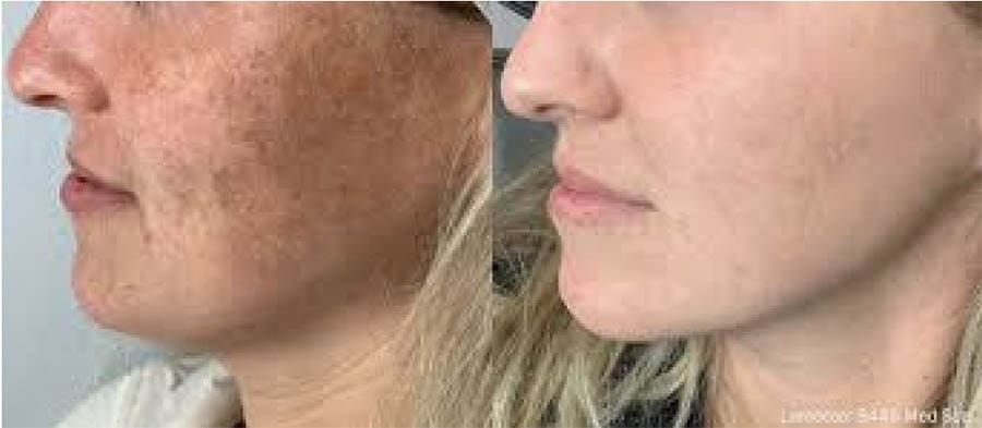 IPL before and after